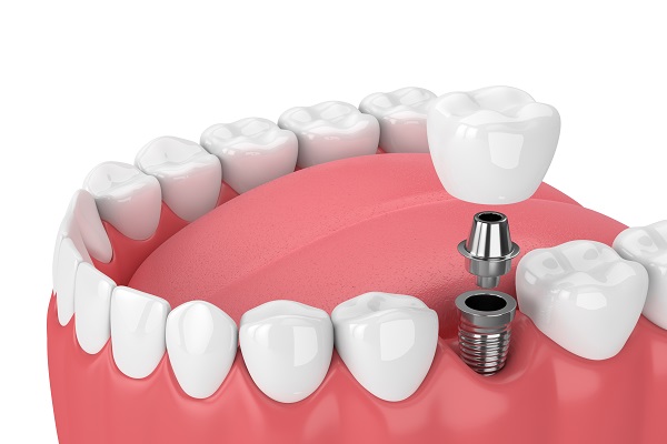Can Multiple Dental Implants Be Placed At The Same Appointment?