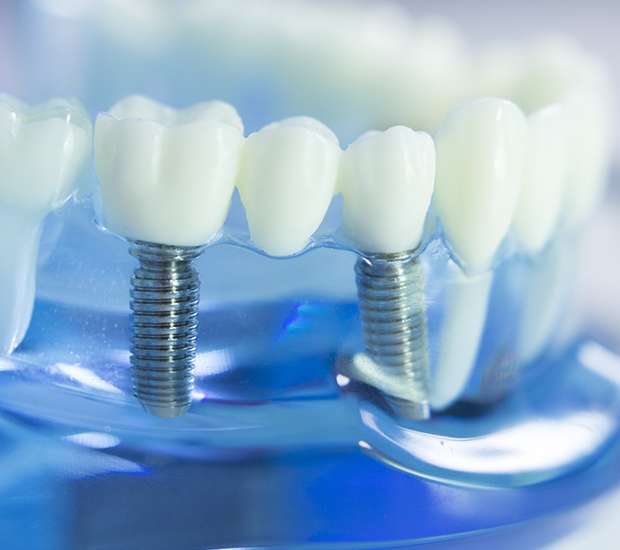 Safford Dental Implants